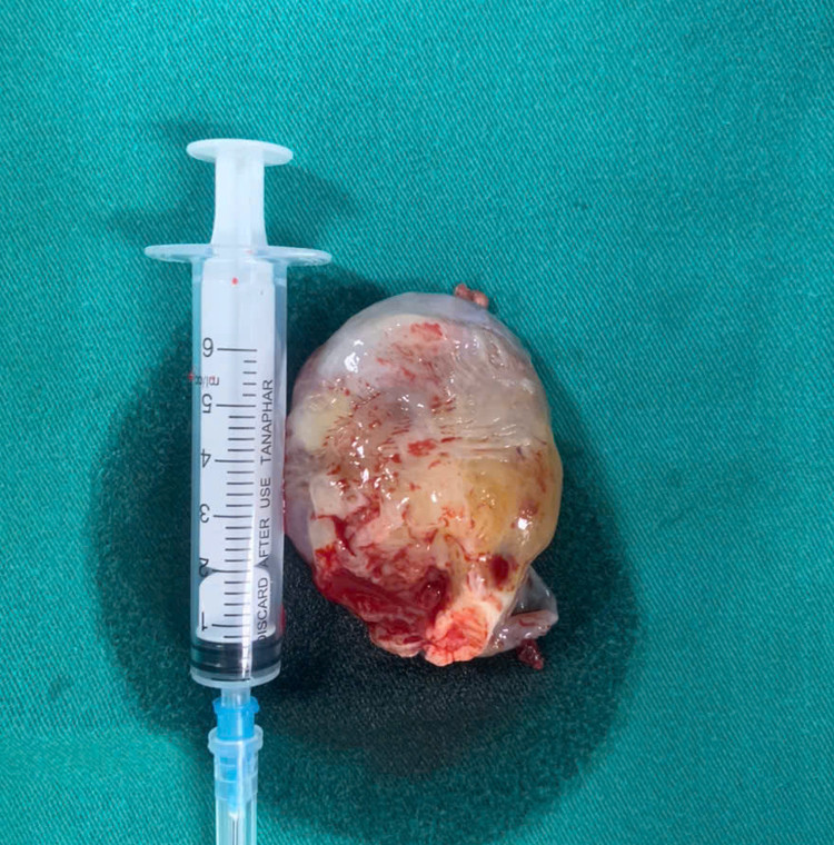 Hình ảnh khối u sau khi được lấy ra - Ảnh BVCC