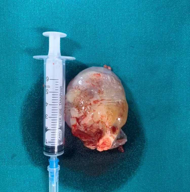 Khối u tim được lấy ra từ bệnh nhân - Ảnh BVCC