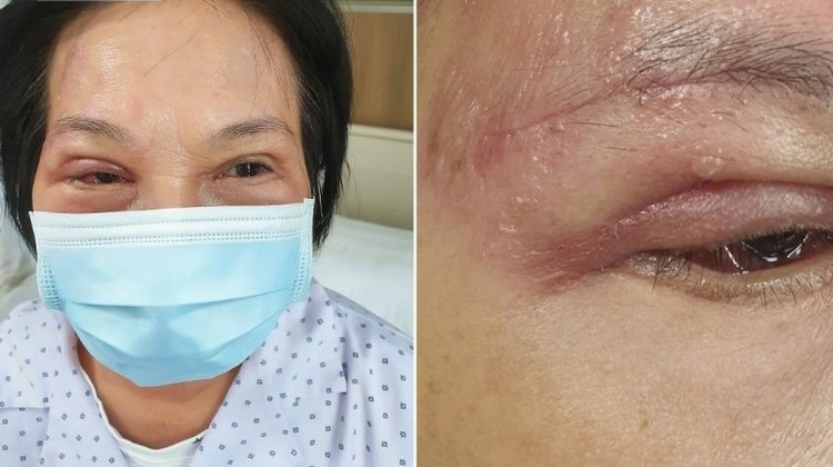 Bà Như, 55 tuổi, bị zona thần kinh tấn công vào mắt - Ảnh BVCC