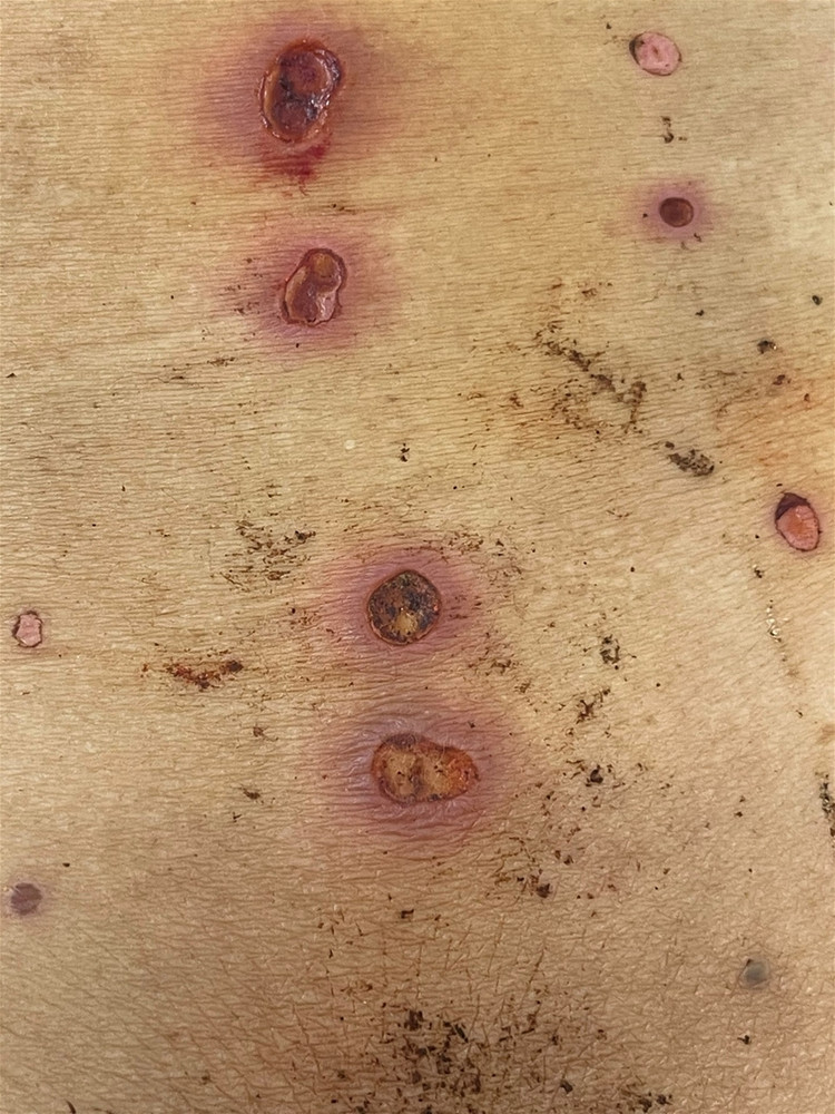 Da tấy đỏ, lở loét vì chữa đau lưng ở “thầy lang”