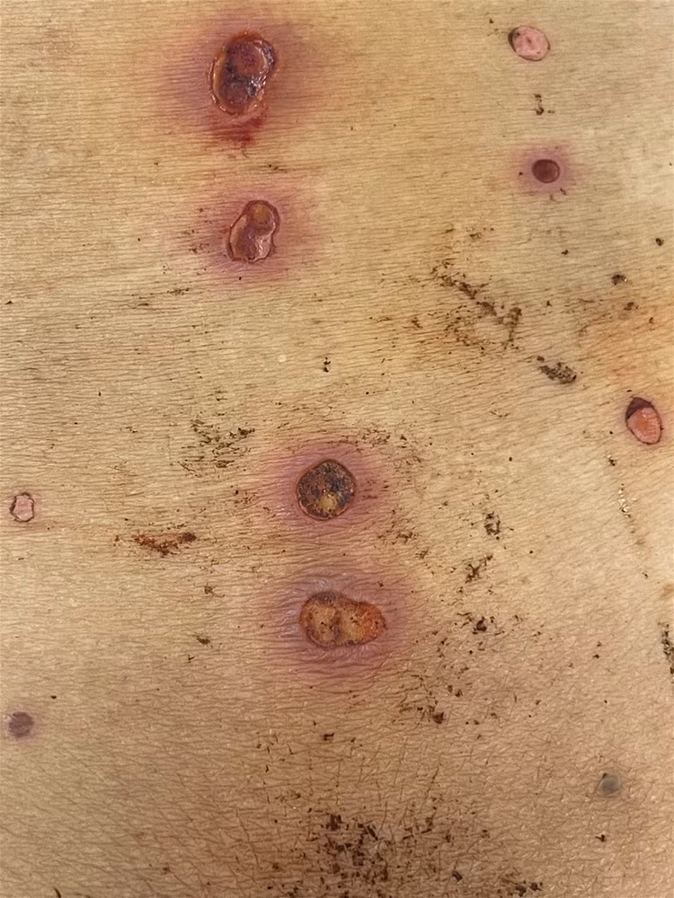 Da tấy đỏ, lở loét vì chữa đau lưng ở “thầy lang”