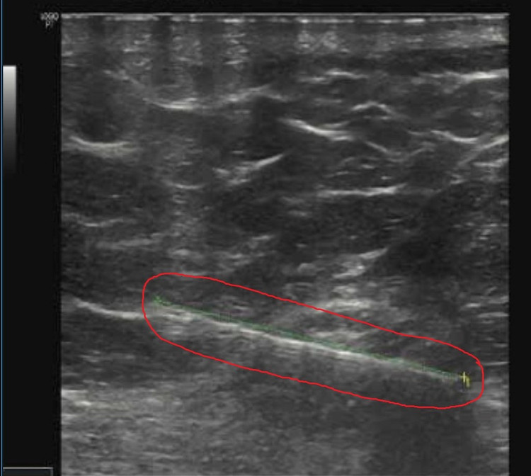 Chiếc kim trong cơ thể cô gái trên phim chụp