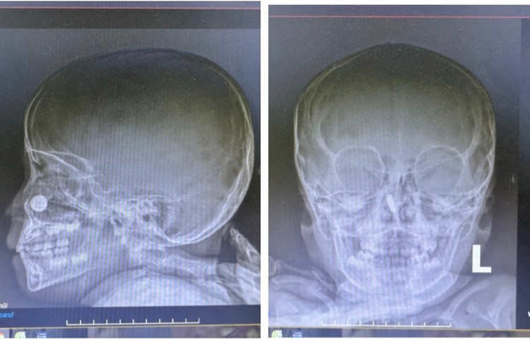 Kết quả chụp X-quang sọ não mặt thẳng/nghiêng cho thấy có dị vật ở mũi bệnh nhi - Ảnh BVCC