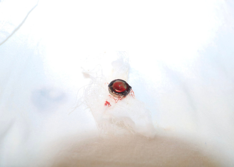 Viên pin cúc có đường kính khoảng 01cm được lấy ra từ mũi phải của bệnh nhi