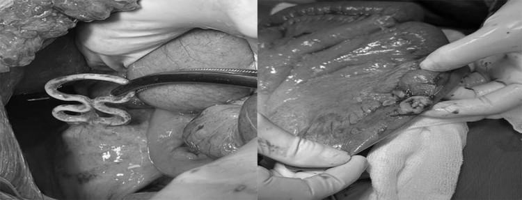 Dụng cụ tử cung lạc chỗ đâm xuyên tử cung, thủng ruột non - Ảnh BVCC