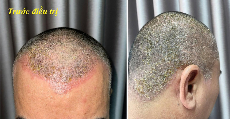 Bệnh nhân bị dị ứng do thuốc nhuộm tóc - Ảnh BVCC