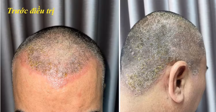 Bệnh nhân bị dị ứng do thuốc nhuộm tóc - Ảnh BVCC