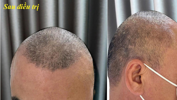 Tổn thương da đầu đã lành sau điều trị - ảnh BVCC