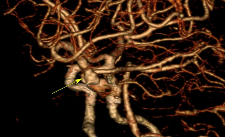 Điểm phình mạch máu não bị vỡ qua chụp mạch - Ảnh BVCC