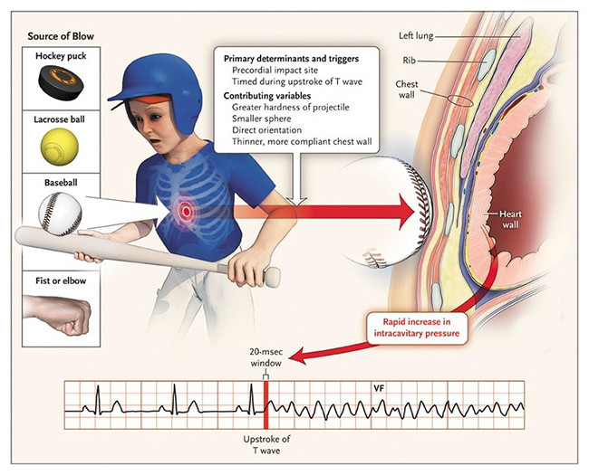 Cơ chế: một lực tác động vào vùng ngực trong thời gian tái cực tâm thất gây ra rung thất - Ảnh BSCC