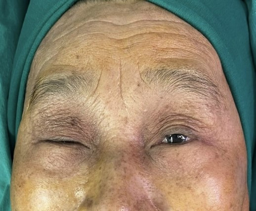 Bệnh nhân sụp mi trước mổ - Ảnh BVCC