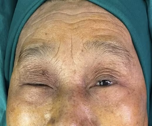 Bệnh nhân sụp mi trước mổ - Ảnh BVCC