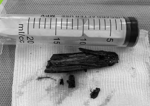 Dị vật là đoạn gỗ mục dài 6m - Ảnh: Lê Hiếu Dị vật là đoạn gỗ mục dài 6m - Ảnh: Lê Hiếu