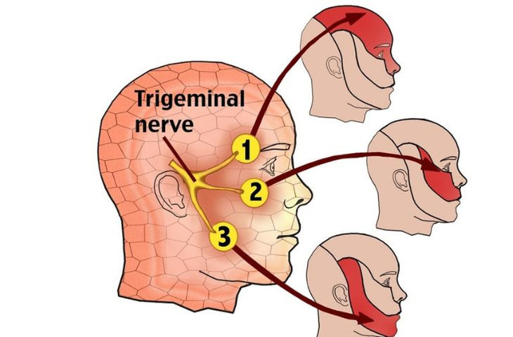 Hình ảnh dây thần kinh 5 - Ảnh BVCC