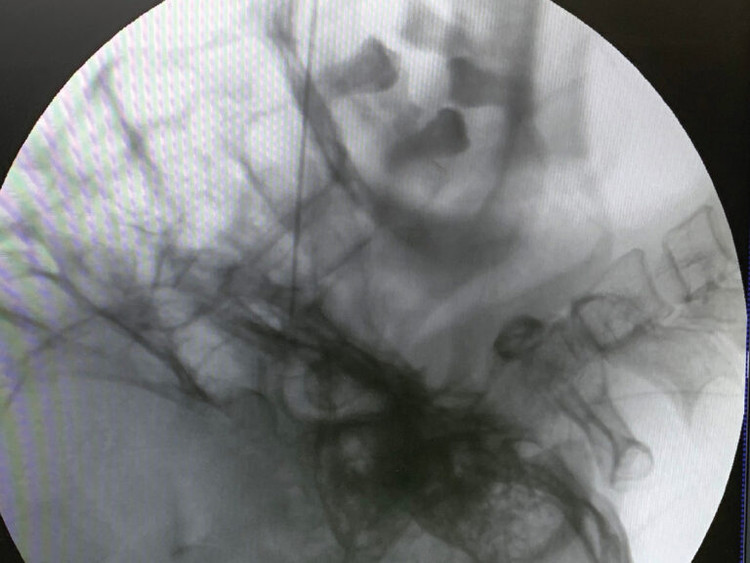 Hình ảnh kim đốt sóng cao tần - Ảnh BVCC