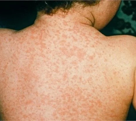 Xuất hiện ca mắc rubella đầu tiên trong năm 2024 tại Hà Nội