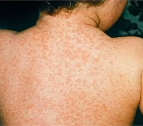 Xuất hiện ca mắc rubella đầu tiên trong năm 2024 tại Hà Nội