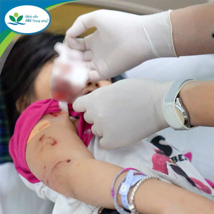 Bé H.A được sơ cấp cứu kịp thời và chuyển đến Bệnh viện Nhi Trung ương - Ảnh: BVCC