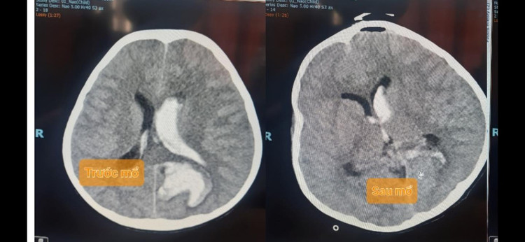Hình ảnh phim chụp não của bệnh nhi - ảnh BVCC