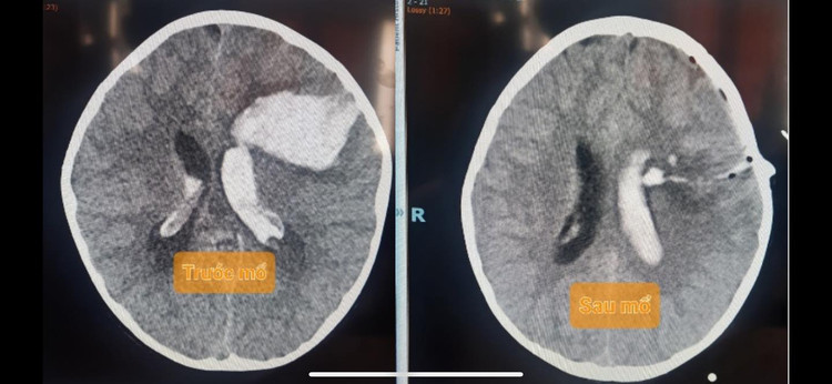 Hình ảnh phim chụp não của bệnh nhi - ảnh BVCC