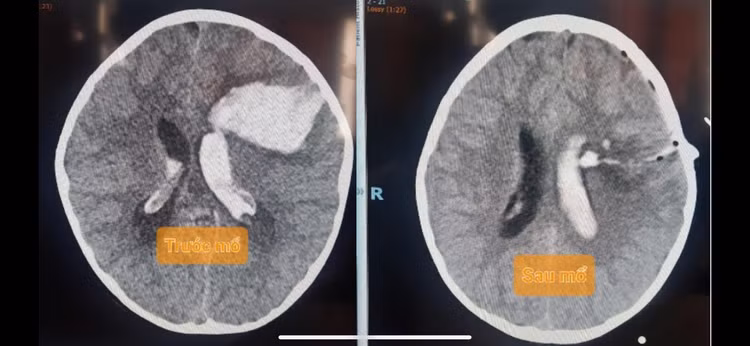 Hình ảnh phim chụp não của bệnh nhi - ảnh BVCC Hình ảnh phim chụp não của bệnh nhi - ảnh BVCC