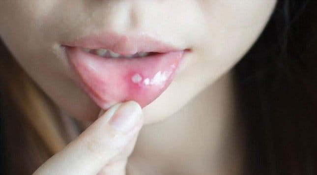 Bác sĩ mách cách phòng chống nhiệt miệng đơn giản - ảnh Minh họa BSCC