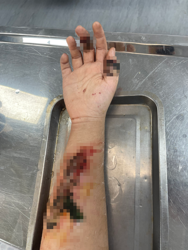 Đắp lá vào vết thương do kính vỡ, thanh niên 17 tuổi hoại tử tay - Ảnh: BVCC