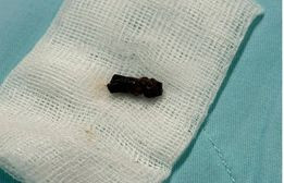 Dị vật cuống hạt xoài trong đường thở bé trai 8 tháng được lấy ra - Ảnh BVCC