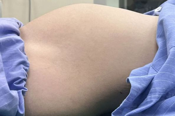 Thiếu nữ mang u buồng trứng tương đương thai 6 tháng - ảnh BVCC