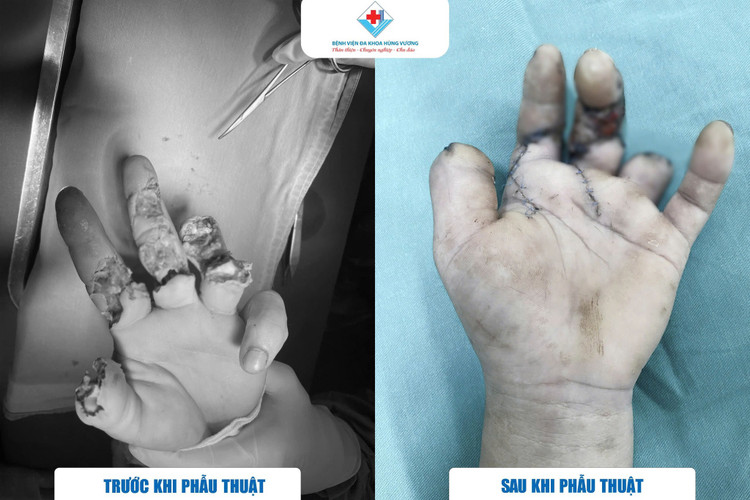 Dùng máy cưa sắt, thanh niên 39 tuổi phải vi phẫu trồng lại các ngón tay ảnh 2