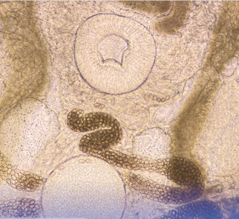 Nội soi phát hiện sán lá ruột nhỏ trong đại tràng bệnh nhân - ảnh BVCC