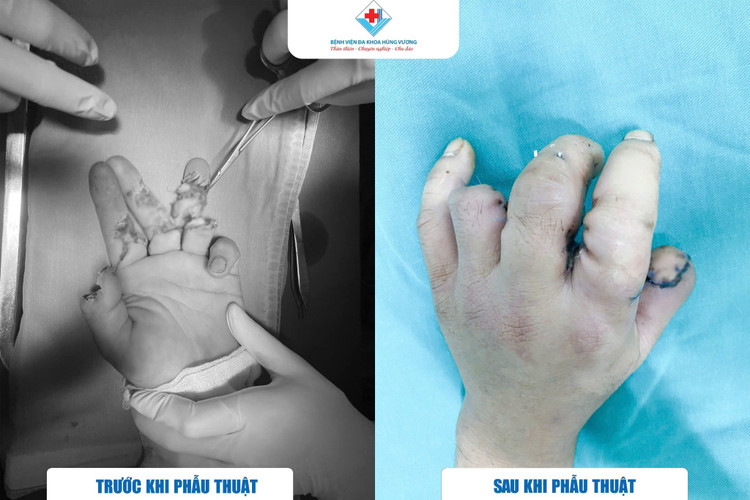 Dùng máy cưa sắt, thanh niên 39 tuổi phải vi phẫu trồng lại các ngón tay ảnh 1 Dùng máy cưa sắt, thanh niên 39 tuổi phải vi phẫu trồng lại các ngón tay ảnh 1