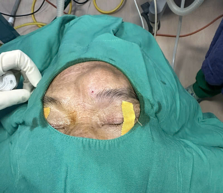 Khối u có kích thước 4x5cm - Ảnh BVCC