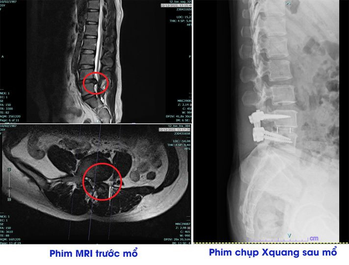 Phim chụp thoát vị đĩa đệm của bệnh nhân