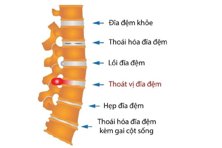 Giải ép thần kinh tránh tàn phế cho người thoát vị địa đệm ảnh 2