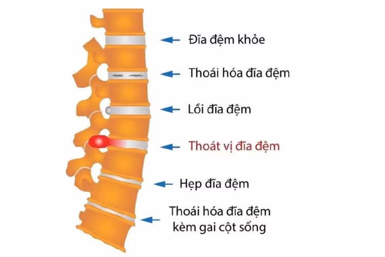 Giải ép thần kinh tránh tàn phế cho người thoát vị địa đệm ảnh 2