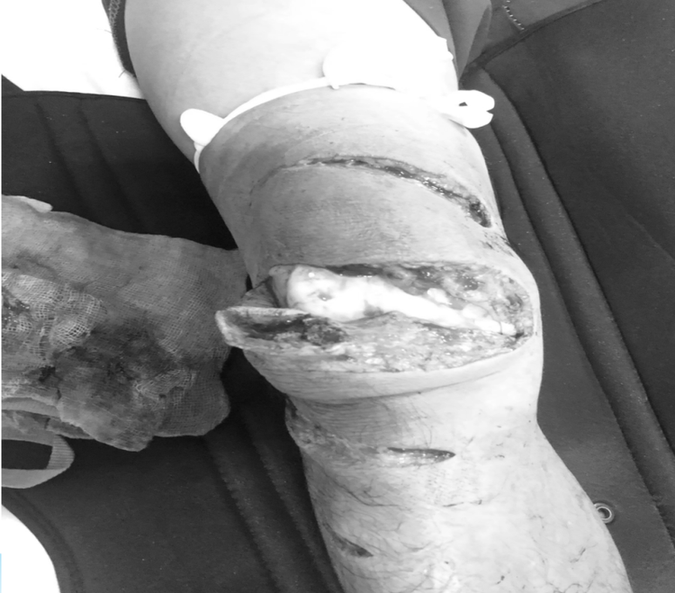 Vết thương phức tạp gối, đùi trái.