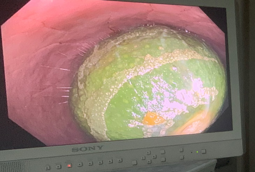 Nội soi trực tràng thất bại do dị vật là quả chanh ở trực tràng. Ảnh:BVCC