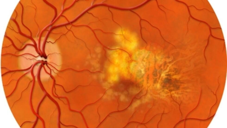 Thoái hóa hoàng điểm là căn bệnh gây mù lòa ở người già