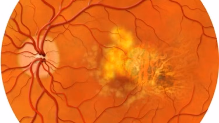 Thoái hóa hoàng điểm là căn bệnh gây mù lòa ở người già