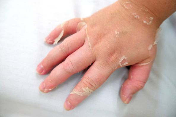 Lạm dụng thuốc xịt mũi, hai anh em ruột bị suy tuyến thượng thận ảnh 2