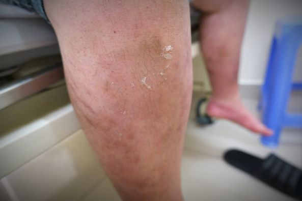 Lạm dụng thuốc xịt mũi, hai anh em ruột bị suy tuyến thượng thận ảnh 1