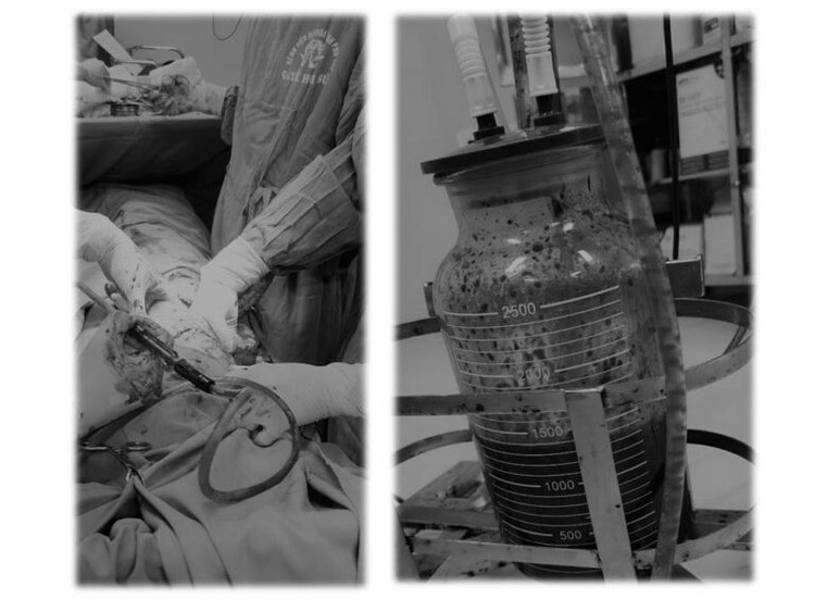 Lượng lớn dịch mủ kèm máu đã được loại bỏ khỏi cơ thể (Khoảng 500 - 700 ml)