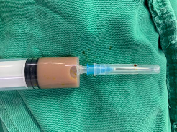 Lượng mủ được lấy ra từ thắt lưng của bệnh nhân ngay tại Khoa Cấp cứu