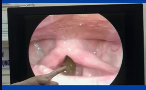 Con đỉa trong cuống họng bệnh nhân qua nội soi