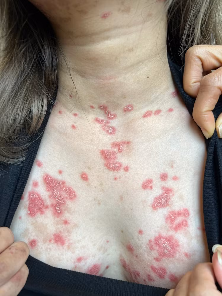 Tổn thương đa cơ quan vì Lupus ban đỏ ảnh 2