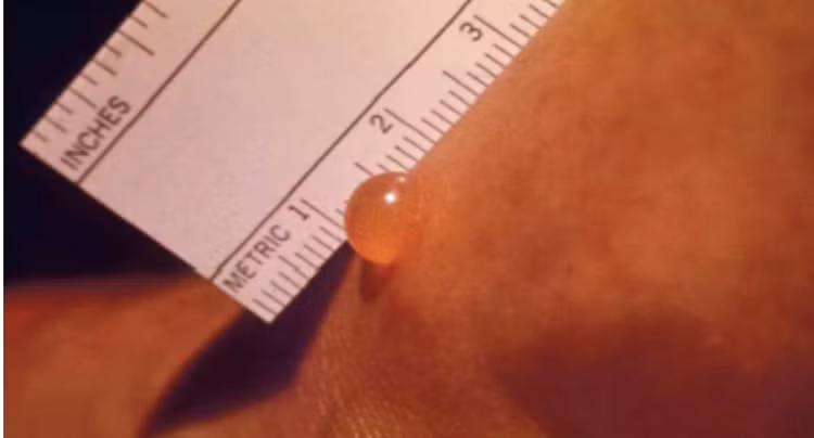 Nốt mò đốt trên cơ thể bé gái