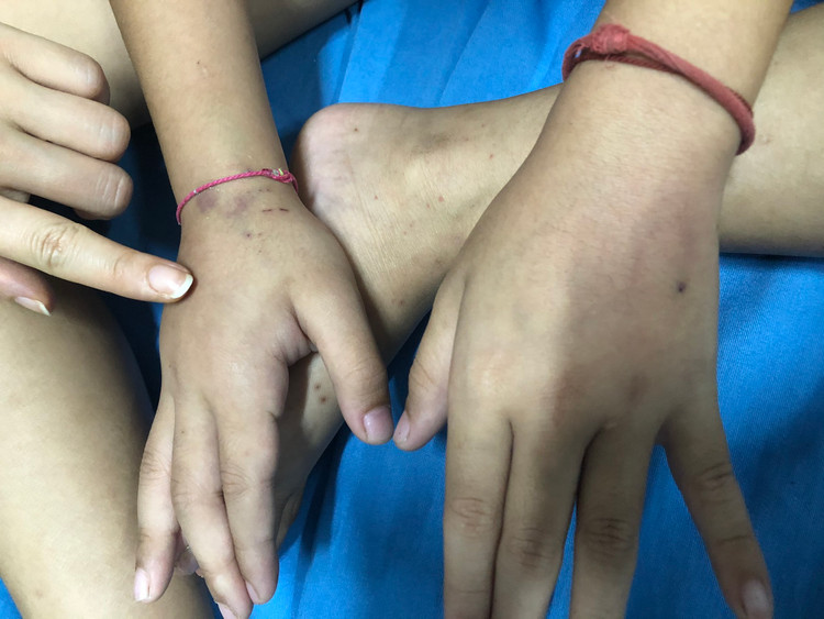 Bé 8 tuổi đau bụng sau ăn không ngờ viêm mao mạch dị ứng nghiêm trọng ảnh 2