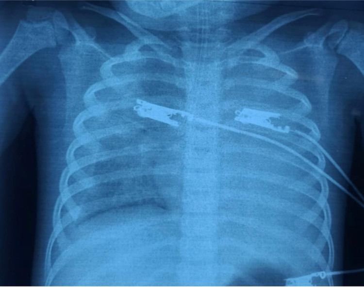 Tổn thương phổi dẫn tới suy hô hấp