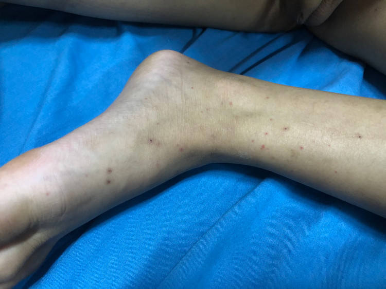 Bé 8 tuổi đau bụng sau ăn không ngờ viêm mao mạch dị ứng nghiêm trọng ảnh 3